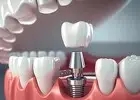 Best Clinic For Dental Implant in Orchard